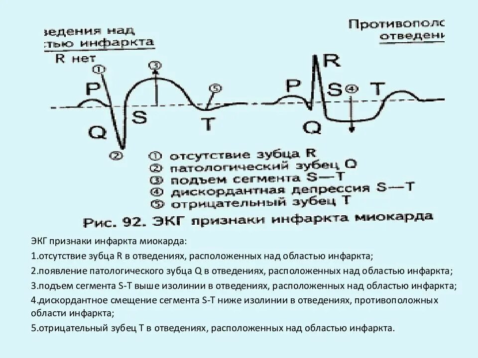 Изменение зубца q. ЭКГ признаки острейшей стадии инфаркта миокарда. Патологический зубец q на ЭКГ при инфаркте миокарда. Признаки острого инфаркта миокарда на ЭКГ. Признаки ОИМ на ЭКГ.