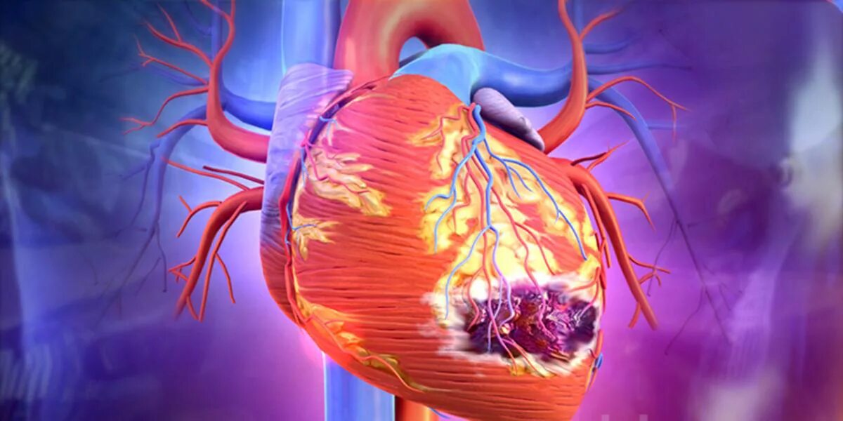 Осложнение на сердце после. Ишемическая болезнь инфаркт миокарда. Сердце при инфаркте миокарда. Infrakt Miokart. Инфаркт Мио Арда.