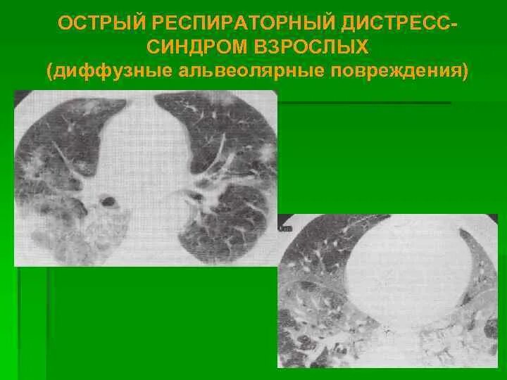 Дистресс синдром взрослых. Острый респираторный дистресс-синдром. Респираторный дистресс-синдром взрослых. Острый респираторный дистресс-синдром взрослых. ОРДС У взрослых.