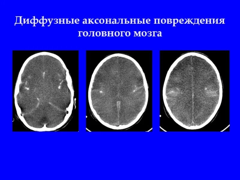 Диффузное аксональное повреждение. Диффузное аксональное повреждение кт. диффузное аксональное повреждение при чмт. диффузное аксональное повреждение мрт. аксональные повреждения головного мозга.