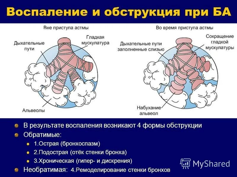 Патогенез астмы. Альвеолы при астме. Препаратами, усиливающими обструкцию. Кашлевая бронхиальная астма. Дифференциальный диагноз хобл и хронического бронхита.