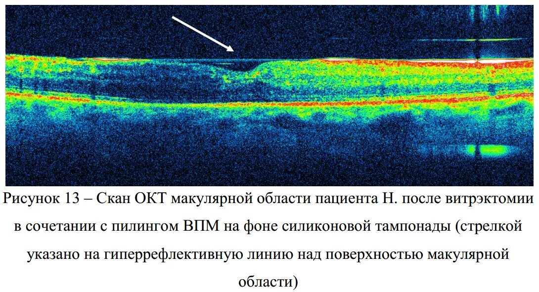 Оптическая когерентная томография. Оптическая когерентная томография диска зрительного нерва. Макулярный разрыв сетчатки глаза. Диабетический макулярный отек. Макулярный разрыв после операции