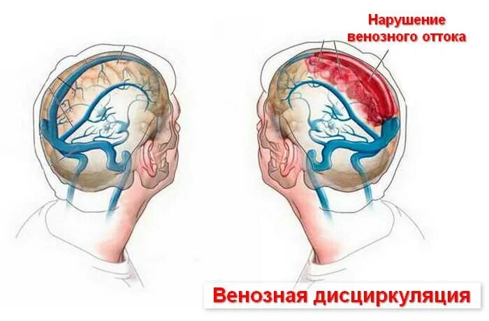 Венозная дисциркуляция головного мозга. Венозная дисциркуляция головного мозга симптомы. Упражнения венозного оттока головного мозга. Нарушение венозного оттока. Нарушение оттока венозной крови.