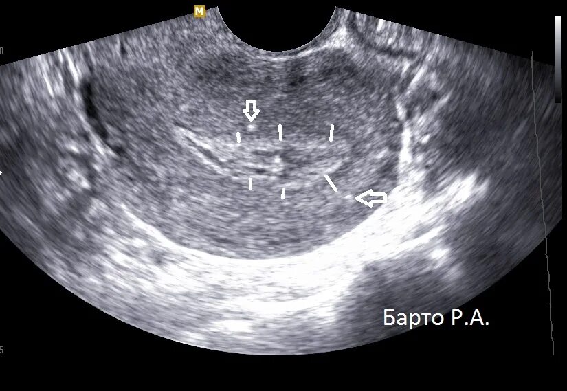 Узловая форма аденомиоза матки на УЗИ. Диффузные изменения миометрия аденомиоз