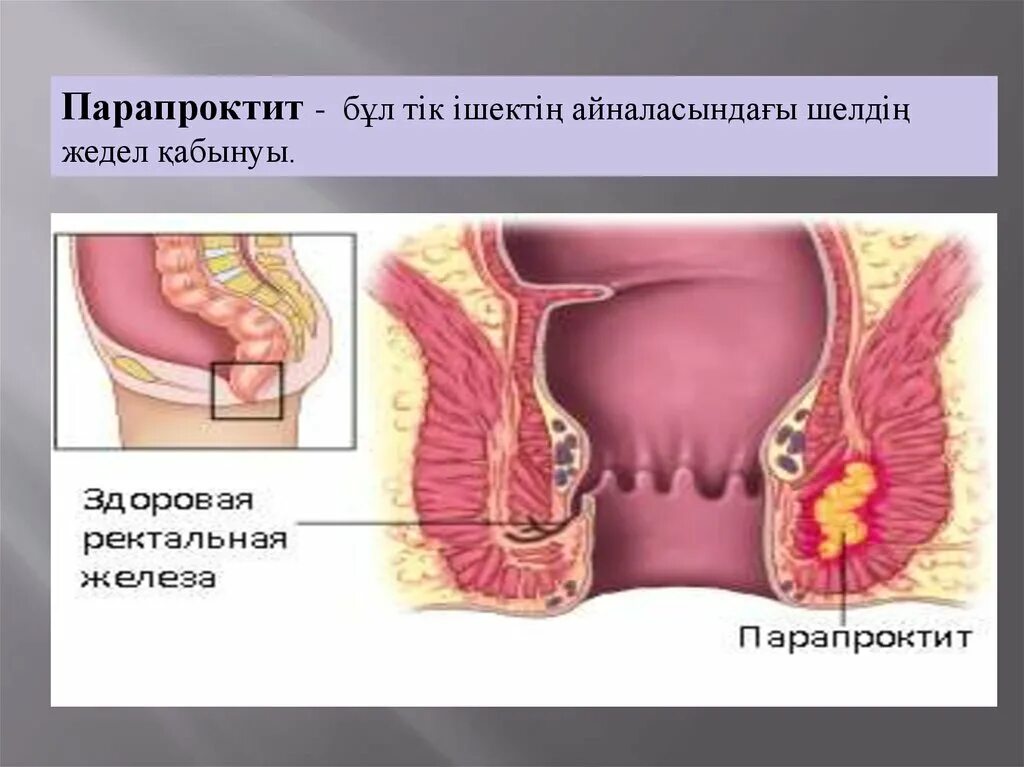 Ректальный рак. Острый пельвиоректальный парапроктит. Пельвиоректальный парапроктит операция. Пельвиоректальный абсцесс. Острый Гнойный подкожно подслизистый парапроктит.