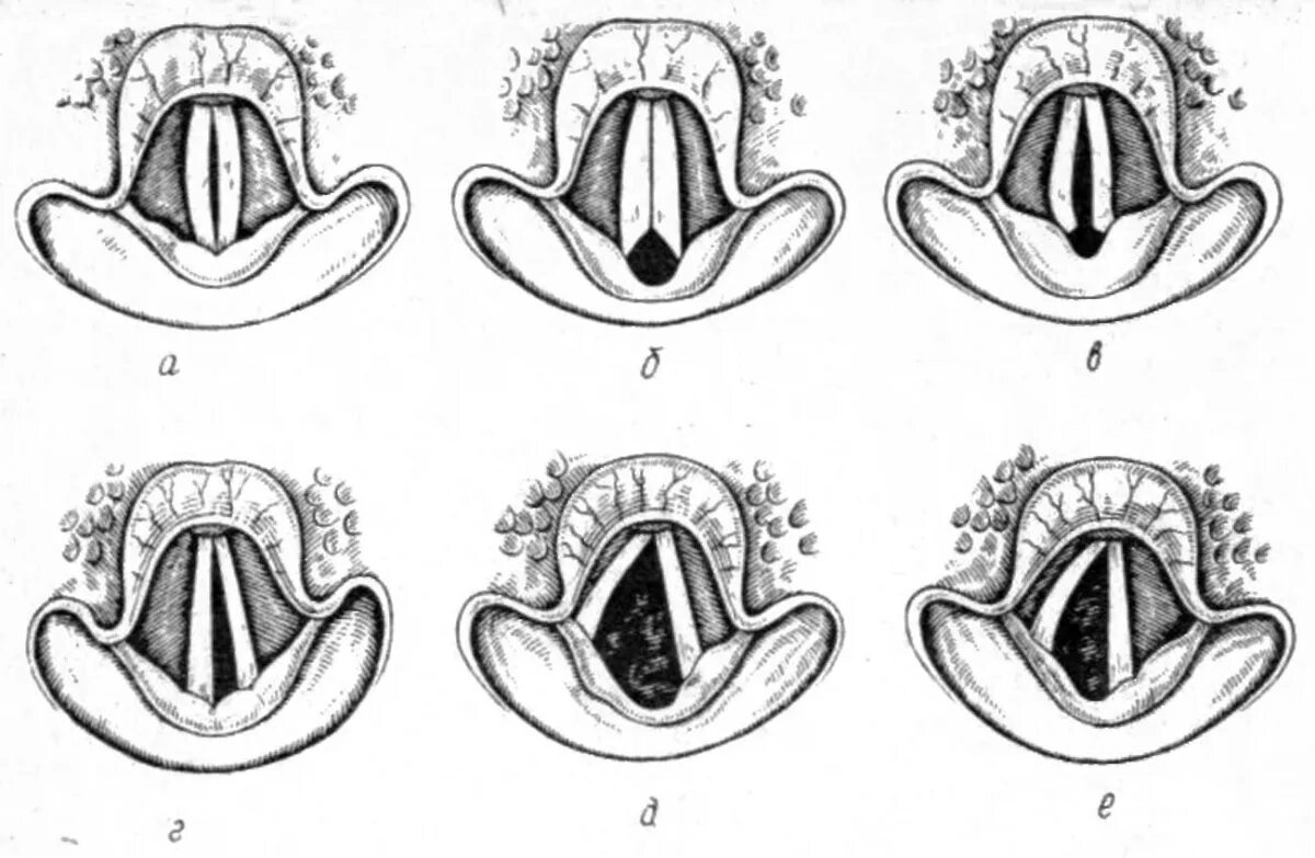 Голосовые связки человека при молчании. Парез и паралич голосовых складок. Парез голосовой складки. Парезы и параличи голосовых связок.