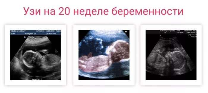 Могли ли ошибиться на 20 неделе. УЗИ скрининг в 20 недель беременности. УЗИ второго скрининга 19 недель. УЗИ 2 скрининг 20 недель. УЗИ на 19 неделе беременности скрининг.