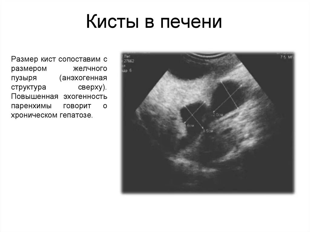 Киста на печени чем опасна у женщины. Киста левой доли печени на УЗИ. Повышенная эхоплотность паренхимы печени. Повышение эхогенности паренхимы это. Желчный пузырь по УЗИ пониженной эхогенностью.