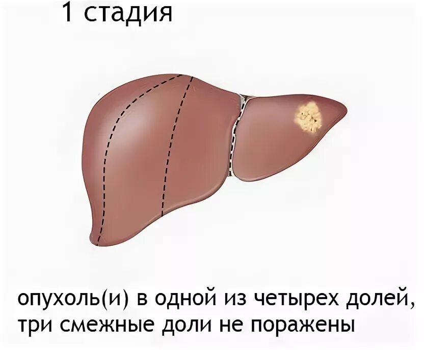 Рак печени 4 стадии прогноз