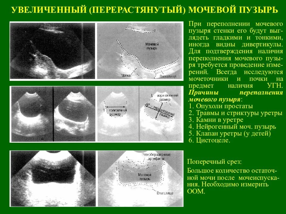 Диффузный мочевой пузырь. УЗИ мочевого пузыря объем остаточной мочи. Нормальные Размеры мочевого пузыря на УЗИ. Гипотония мочевого пузыря на УЗИ. Стриктуры мочевого пузыря УЗИ.