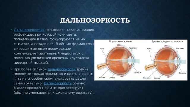 При дальнозоркости световые лучи фокусируются. При дальнозоргости световые лучи фокусируется?. Дальнозоркость лучи света фокусируются. При близорукости лучи света фокусируются за сетчаткой. Лучи света фокусируются за сетчаткой