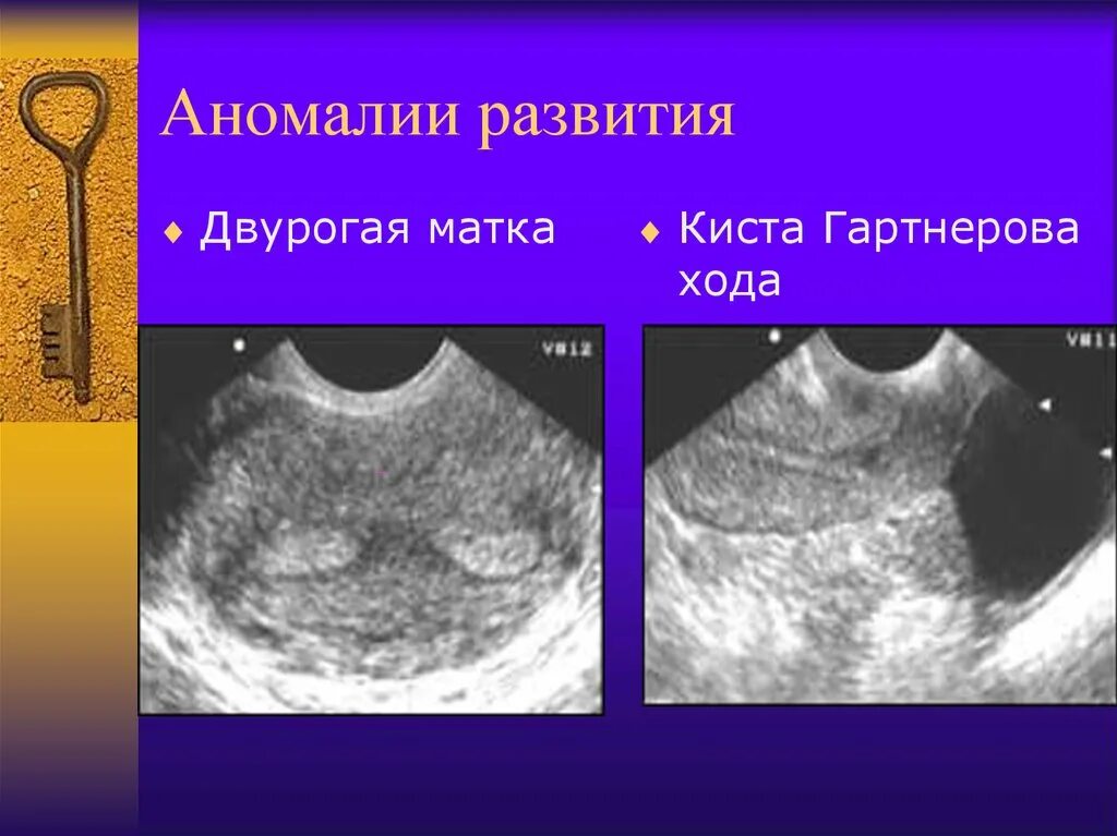 Двурогая седловидная матка. Двурогая матка на УЗИ. Аномалия матки двурогая.