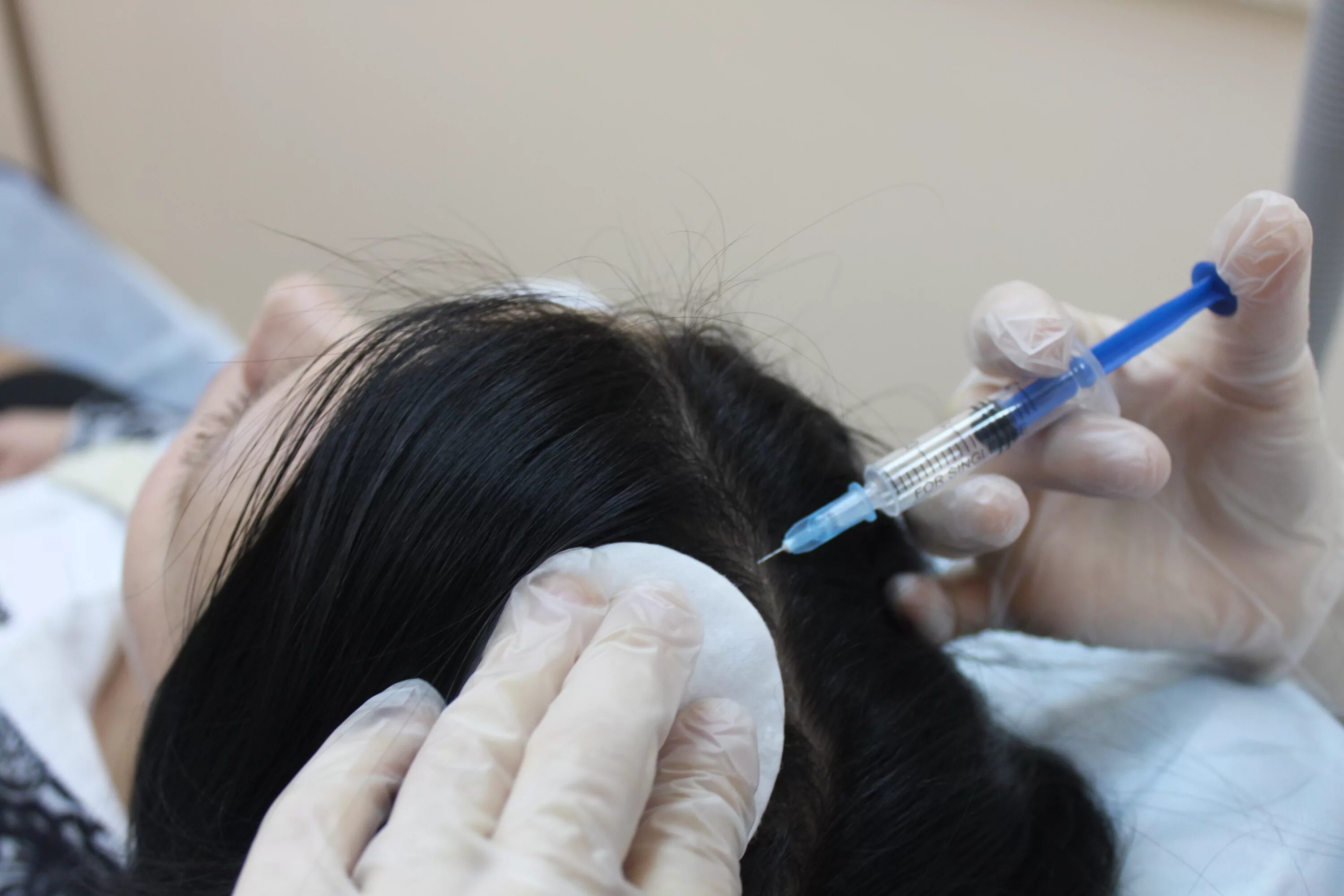Инъекции головы. Мезотерапия для волос. Мезотерапия для кожи головы и волос. Мезотерапия волосистой части головы. Озонотерапия волосистой части головы.