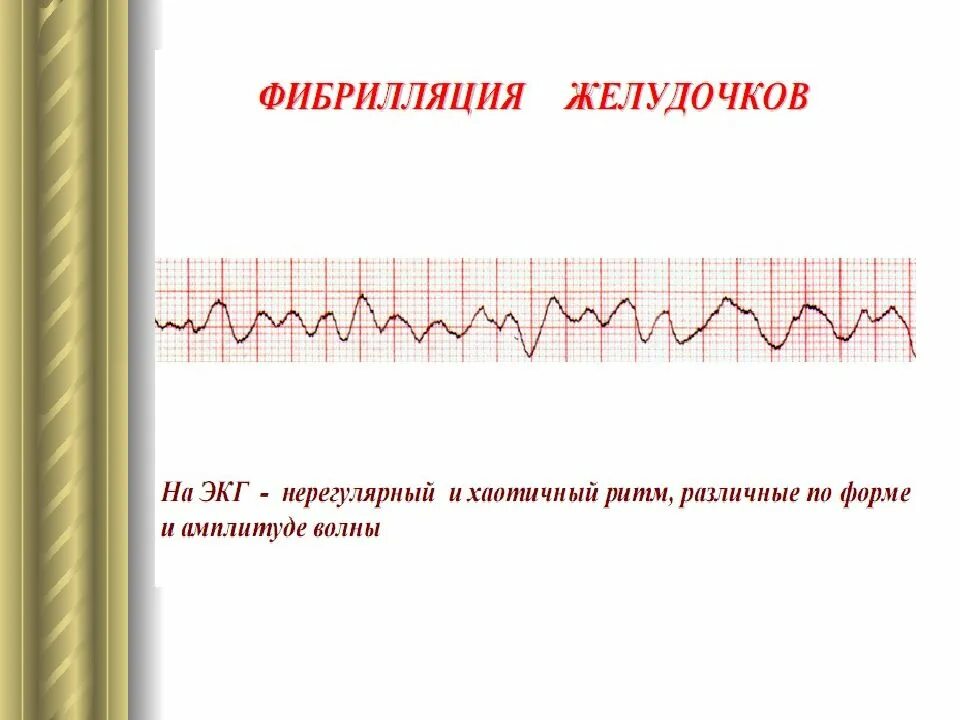 Фибрилляция мышц. Мелковолновая фибрилляция желудочков экг. фибрилляция желудочков на экг. фибрилляция желудочков экг критерии. трепетание желудочков на экг признаки.