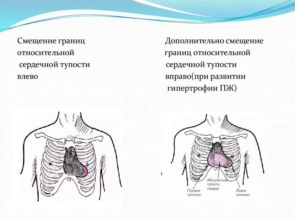 Границы относительной тупости сердца при аортальной недостаточности. Абсолютная тупость сердца при митральной недостаточности. Смещение левой границы относительной тупости сердца. Смещение правой границы относительной тупости сердца.