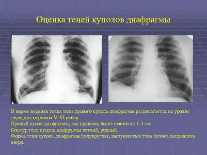 Что значит релаксация правого купола
