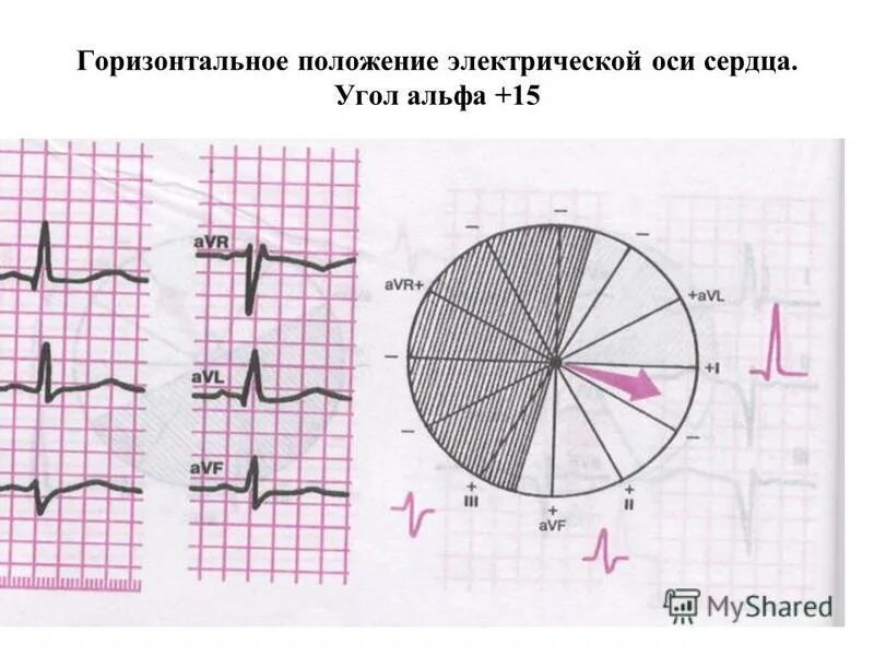 Эос сердца на экг. При экг электрическая ось горизонтальная. Экг оси вертикальная и горизонтальная. Электрическая ось горизонтальная на экг что это. Вертикальная электрическая ось сердца на экг.