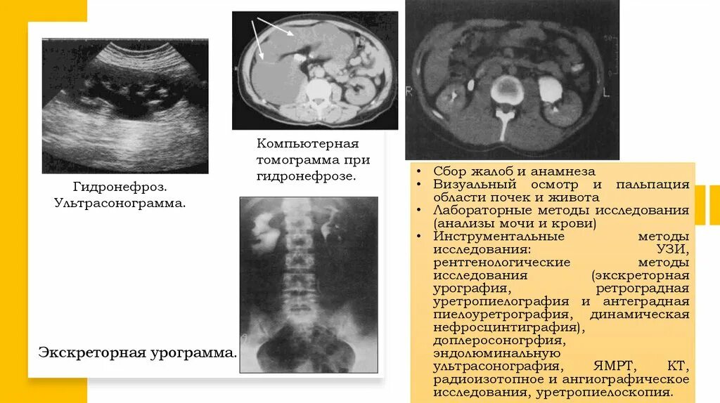 Заболевание почек гидронефроз. Гидронефроз почки кт снимок. УЗИ критерии гидронефроза почки. Кт признаки гидронефроза почек. Гидронефротическая трансформация почки на УЗИ.