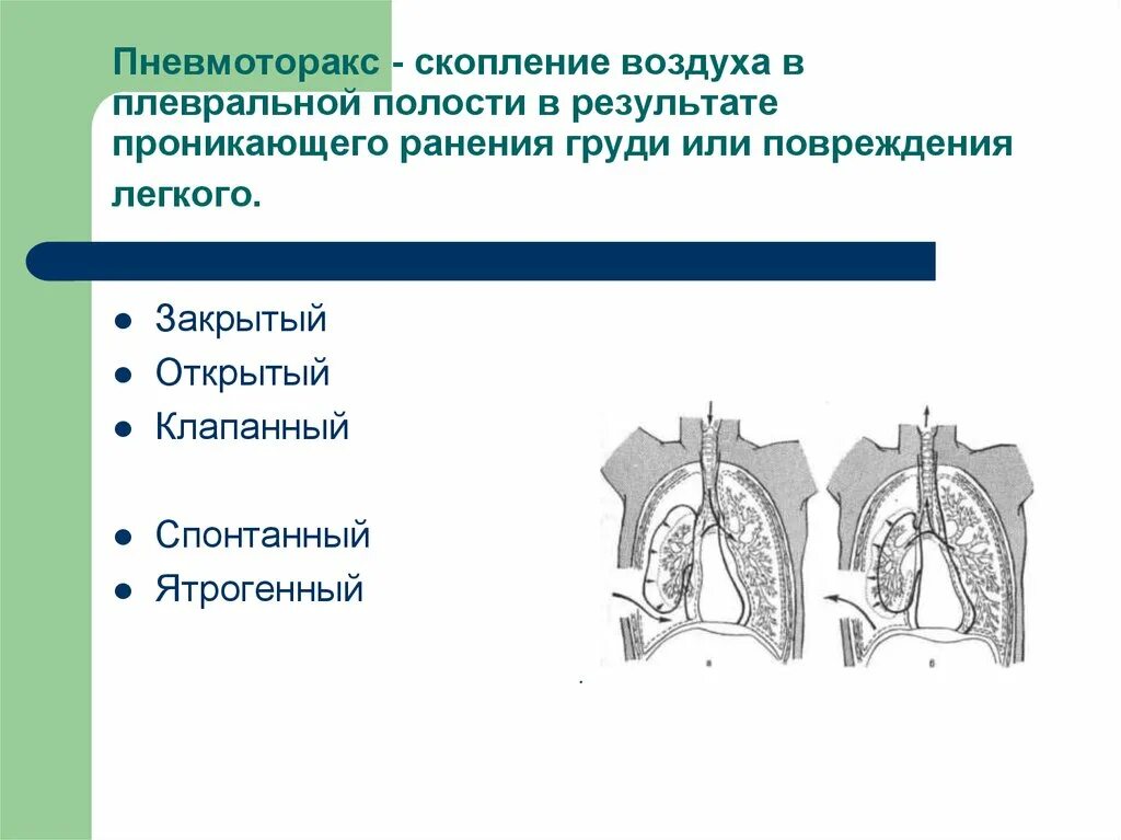 Лечение плевральной полости. Спонтанный пневмоторакс дренирование. Пневмоторакс открытый закрытый клапанный таблица. Клапанный пневмоторакс давление в плевральной полости. Спонтанный пневмоторакс классификация.