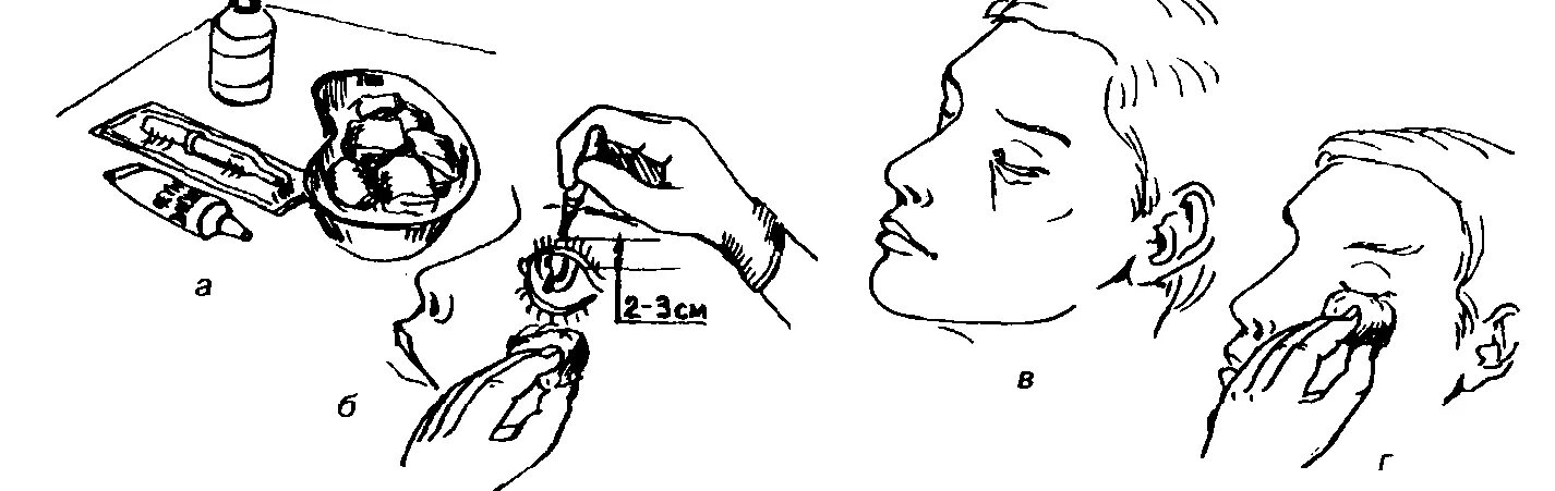 Закапывание в нос глаза уши. Закапывание капель в глаза алгоритм. Алгоритм закапывания капель в глаза пациенту. Закапывание капель и закладывание мази в глаз.. Алгоритм закапывания капли в глаза.