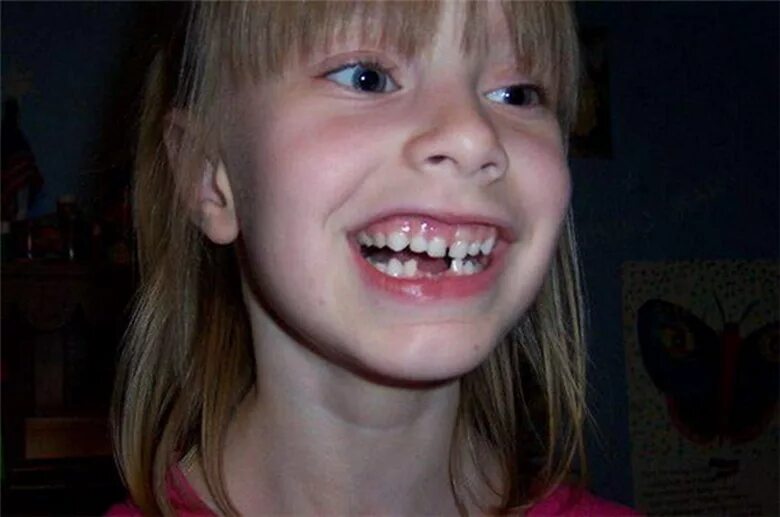 можно ли ходить без зуба