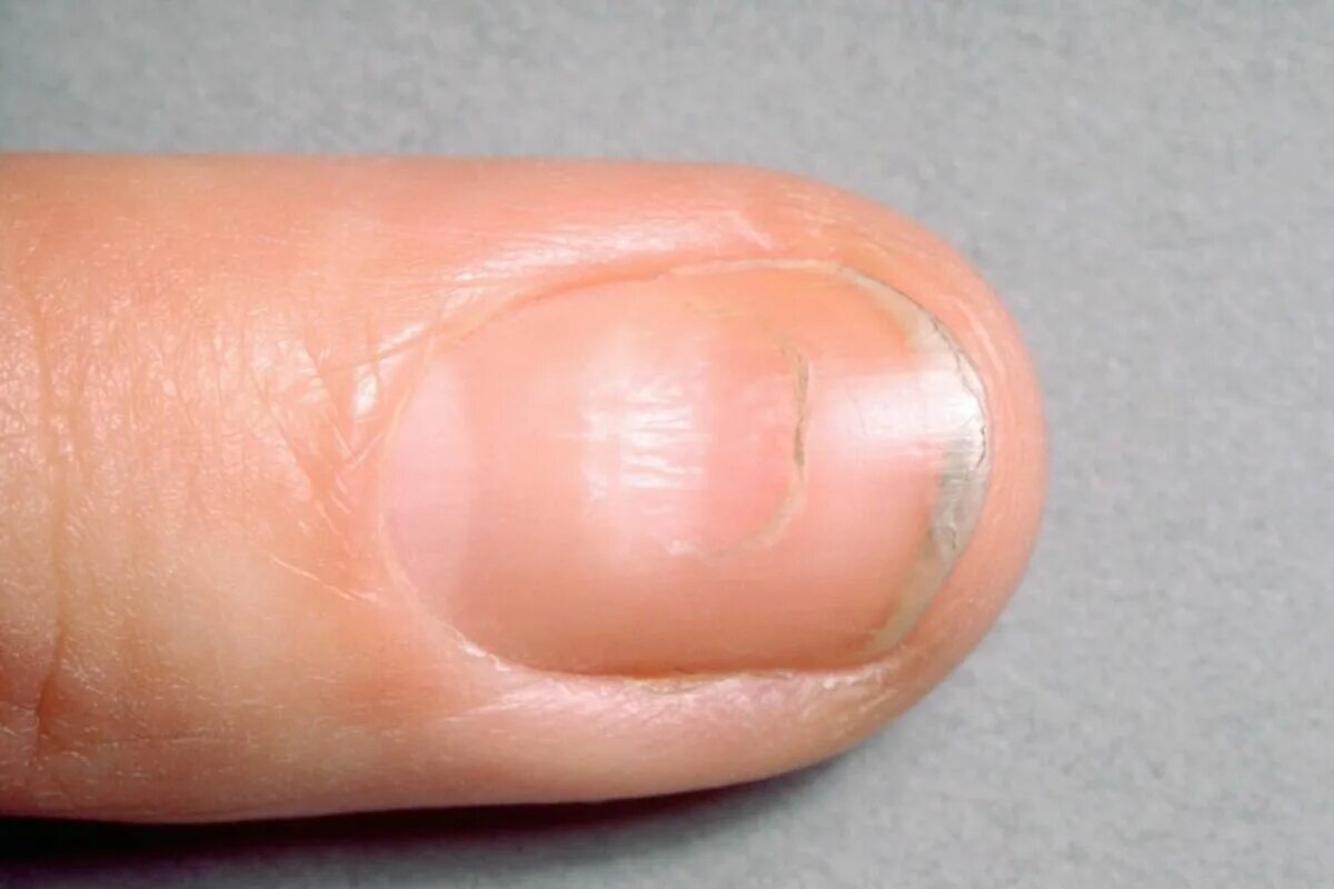 Почему на руке полоска. Продольные полосы на ногтях. Вмятина на ногте большого пальца. Канавка на ногте большого пальца. Поперечные полосы на ногтях.