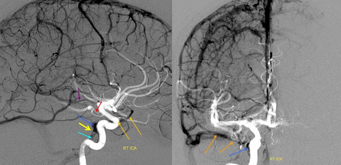 Кт ангиография аневризма головного мозга. Магнитно-резонансная ангиография сосудов головного мозга. Мрт ангиография артерий головного мозга. Каротидная ангиография головного мозга. Тромбоз артерий мозга