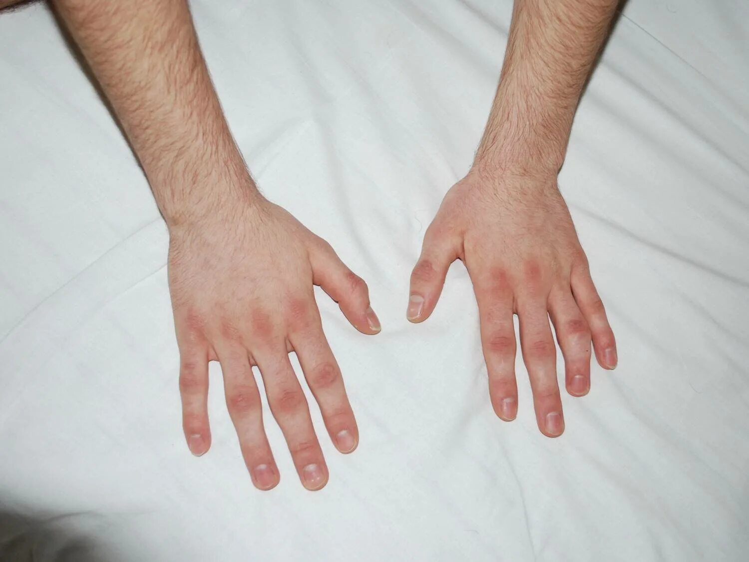 подкожные узелки ревматизм. кожно кожные заболевания суставов. кожно кожные заболевания суставов. геморрагический некротизирующий васкулит. ревматоидный артрит ноги.