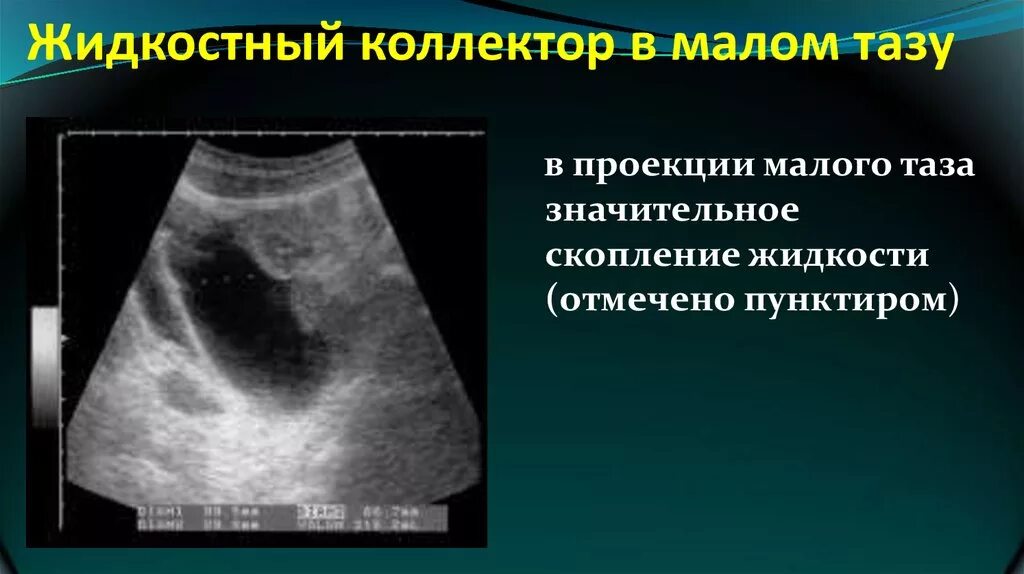 Жидкость в Малом тазу на УЗИ. Свободная жидкость в Малом тазу. Свободная жидкость в Малом тазу на УЗИ. Скопление выпота в полости малого таза. После операции собралась жидкость