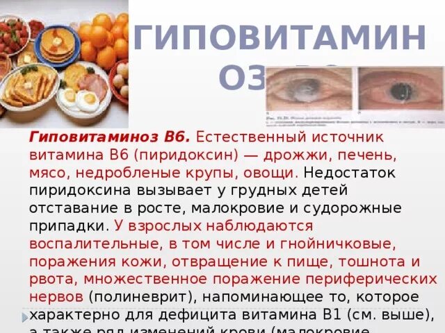 Недостаток б6. Признаки гиповитаминоза витамина б6. Признаки гиповитаминоза витамина в6. Проявление гиповитаминоза витамина б6. Витамин в6 пиридоксин гиповитаминоз.