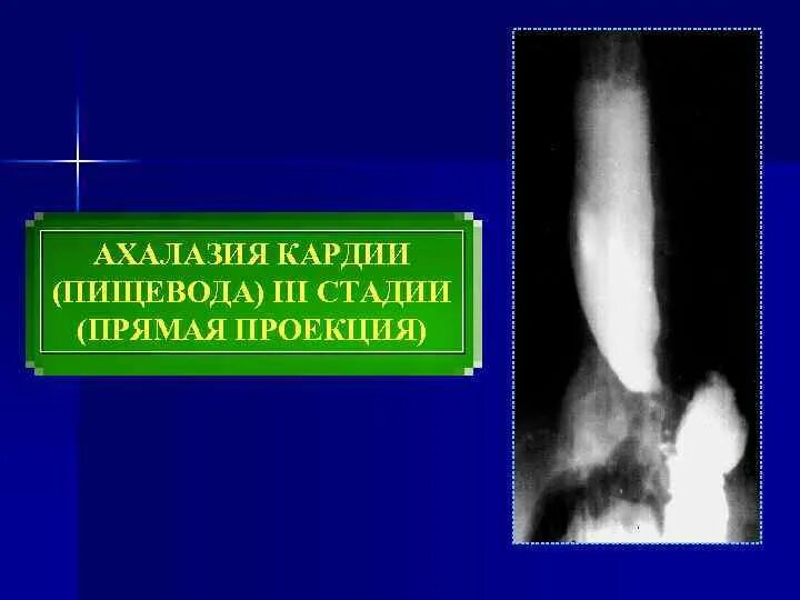 Халазия пищевода. Ахалазия кардии пищевода. Ахалазия пищевода рентген. Степени ахалазии пищевода рентген.