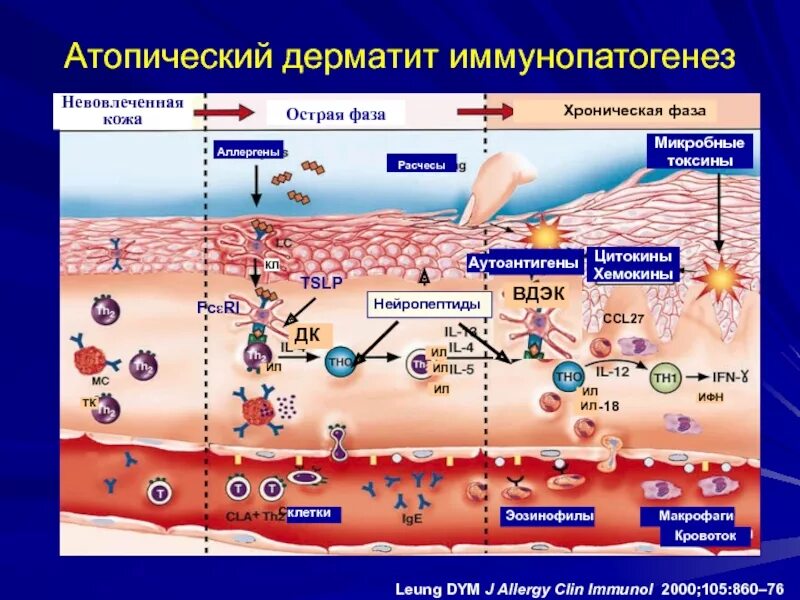 Схема развития атопического дерматита. Атопический дерматит строение кожи. Патогенез атопического дерматита схема. Механизм развития дерматита. Этиология сыпей