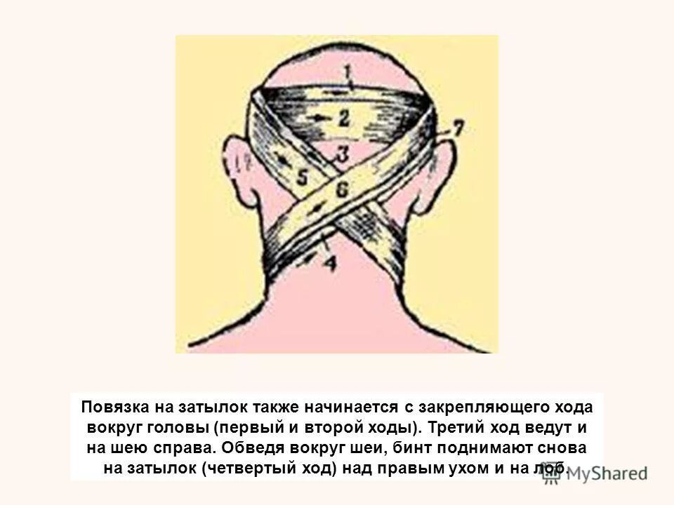 Повязка накладывается при повреждении затылка