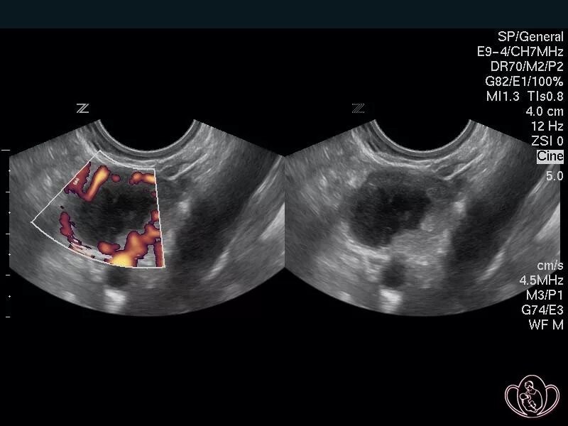 Желтое тело что это значит простыми словами. Киста желтого тела по УЗИ кровоток. Киста желтого тела на УЗИ С кровотоком. Киста фолликул фолликулярная яичника. Киста желтого тела яичника на УЗИ.