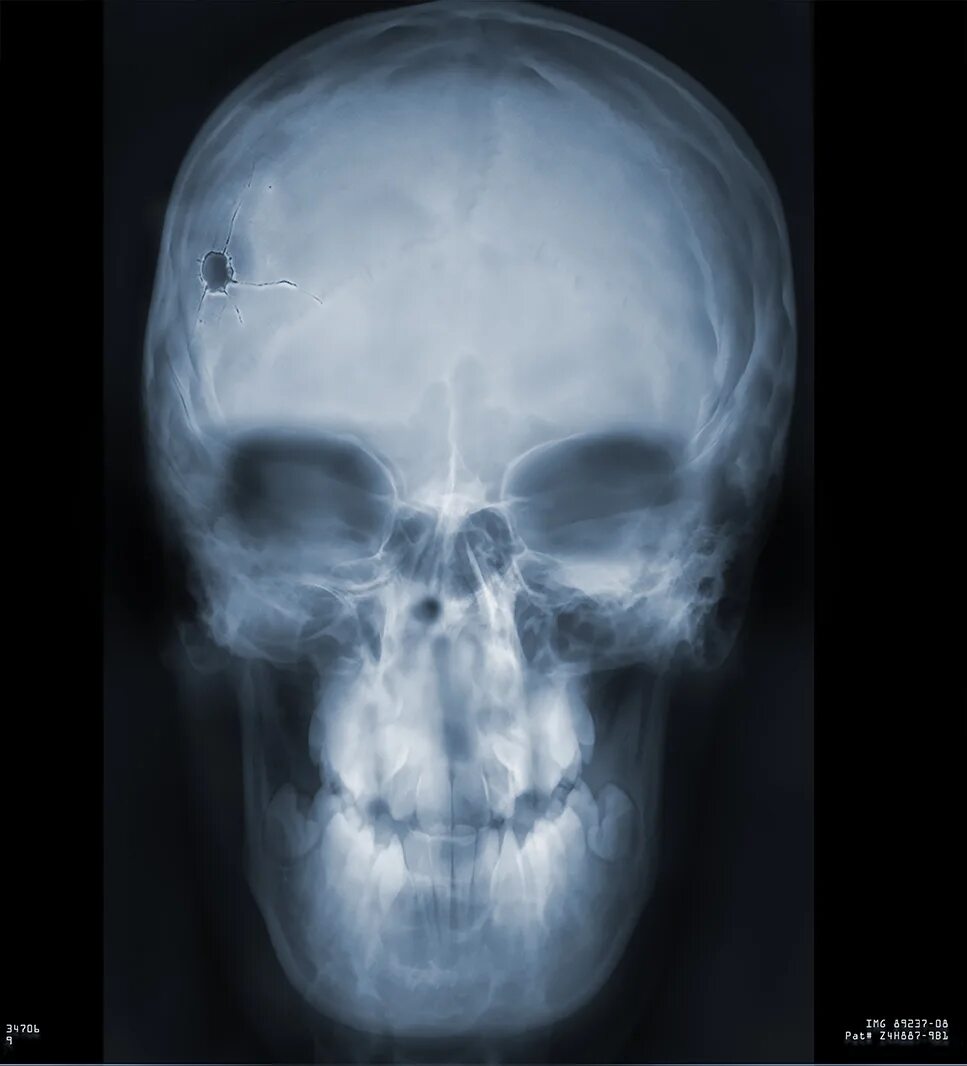 Рентгеновский снимок черепа. Череп с пулевым отверстием.