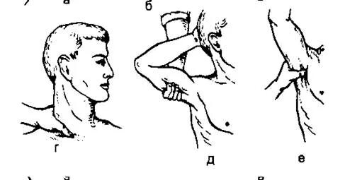 Способы остановки кровотечения пальцевое прижатие артерии. Пальцевое прижатие подкрыльцовой артерии. Пальцевое прижатие подмышечной артерии. Пальцевое прижатие артерий подмышечная артерия. Кровотечение из подмышечной артерии пальцевое прижатие.