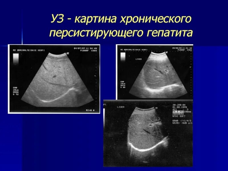 Изменения печени у ребенка. Хронический гепатит УЗИ картина. Заболевания печени на УЗИ.