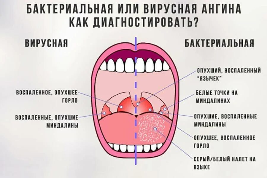 Сколько дней температура при горле