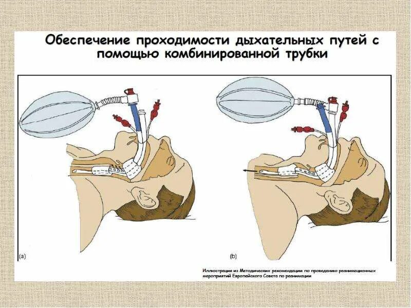 Оборудование для обеспечения проходимости дыхательных путей. Обеспечение проходимости дыхательных путей реанимация. Для обеспечения проходимости дыхательных путей необходимо. Обеспечение проходимости дыхательных путей фото. Проверка проходимости дыхательных путей