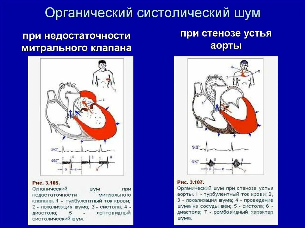 Локализация шума при недостаточности митрального клапана:. Органические систолические шумы. Систолический шум при аортальном. Систолический шум при стенозе устья аорты. Систолический шум это