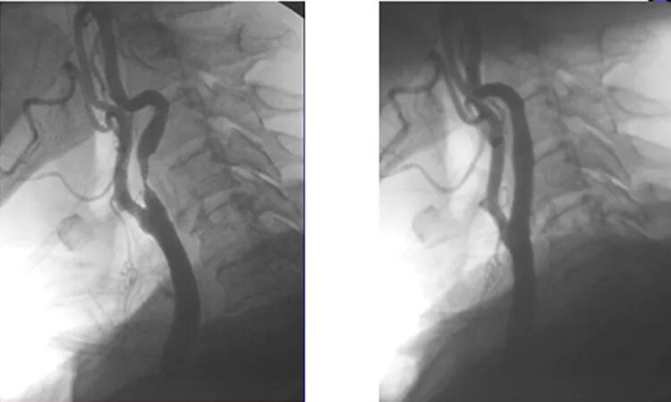 Сужение шейных сосудов. Стеноз внутренней сонной артерии стентирование. Стеноз сонной артерии ангиограмма. Стентирование аорты кт.