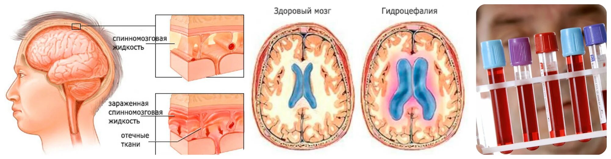 Что такое контузия словами и последствия. Патология мозговые оболочки.