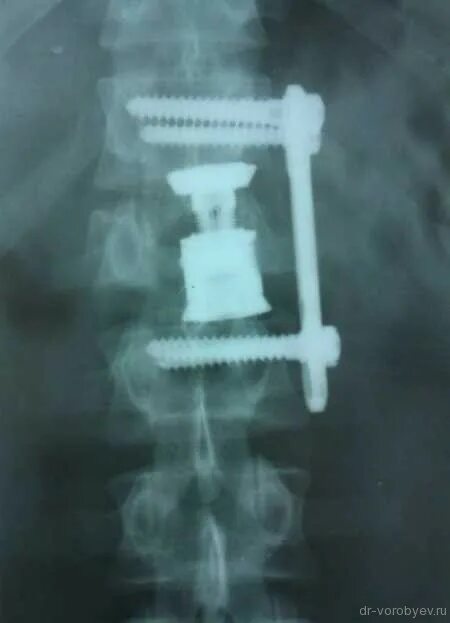 Операция по замене позвоночника. Межтеловой Кейдж. Межтеловой спондилодез Кейджем. Кейдж для позвоночника. Кейдж для позвоночника шейного отдела.
