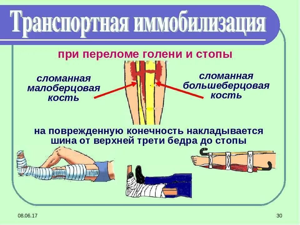 Кровотечение при открытом переломе голени. Транспортная иммобилизация при переломе голени. Перелом костей стопы транспортная иммобилизация. Транспортная иммобилизация при переломе костей конечностей. Шина при переломе большеберцовой кости.