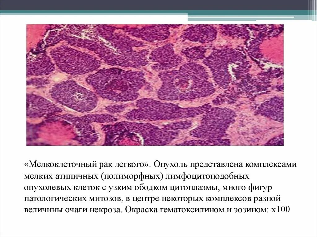 Карцинома легкого гистология. Мелкоклеточная нейроэндокринная карцинома гистология. Опухолевые клетки патанатомия. Мелкоклеточный ракмлегкого. Лечение мелкоклеточного рака