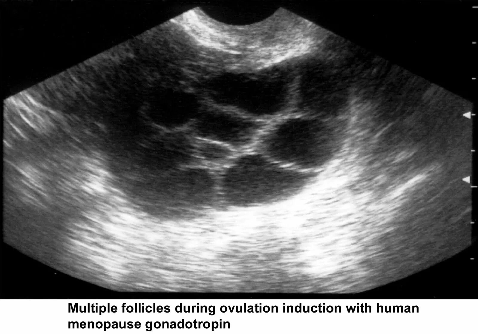 Мультифолликулярные яичники на УЗИ. Поликистоз яичников на УЗИ. Мультифолликулярные поликистоз яичников. УЗИ при мультифолликулярных яичниках.