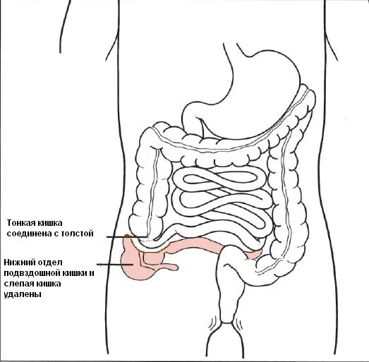 Слепая и подвздошная кишка. Подвздошная кишка Толстого кишечника. Подвздошная кишка анатомия строение. Дистальный отдел подвздошной кишки. Термальный отдел тонкой кишки это.