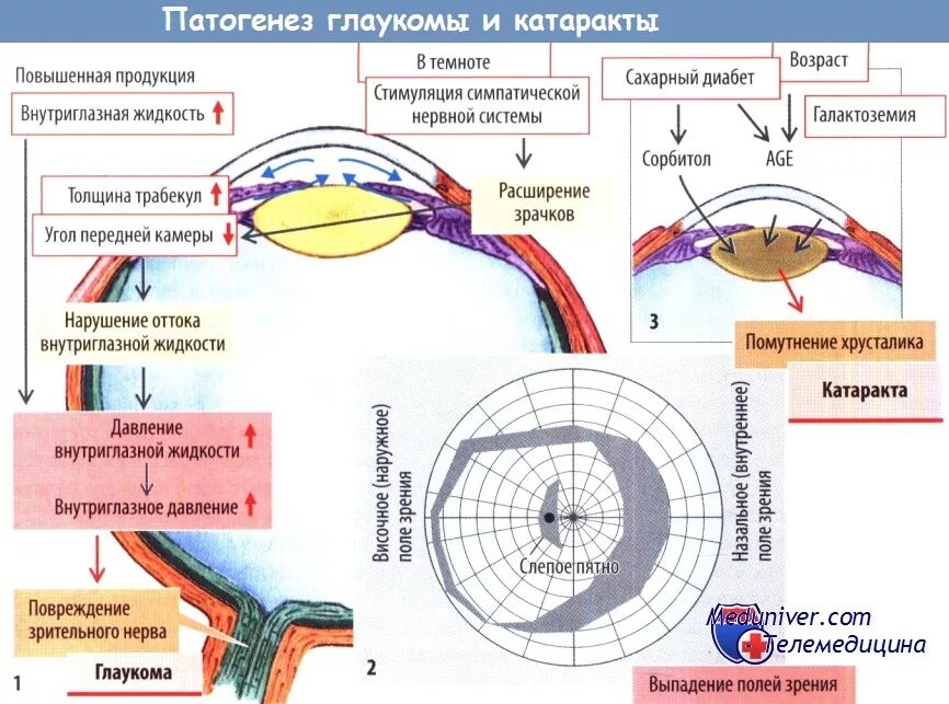 Закрытоугольная глаукома этиология. Патогенез закрытоугольной глаукомы. Патогенез первичной открытоугольной глаукомы. Схема оттока внутриглазной жидкости. Классификация глаукомы