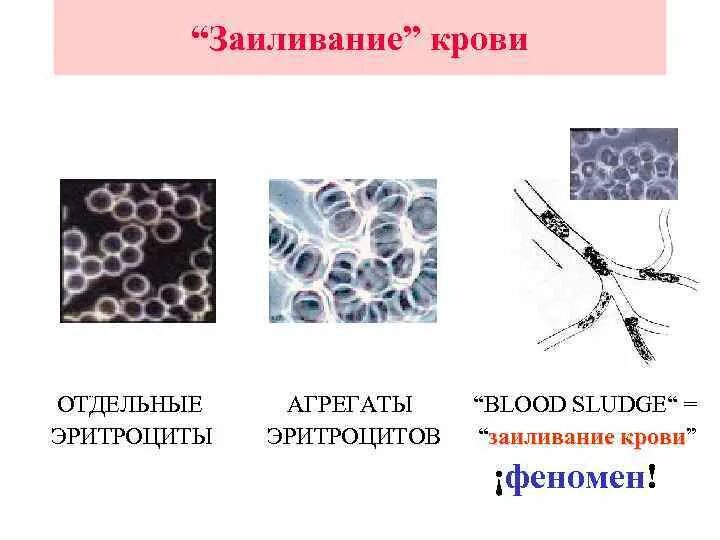 Сладж эритроцитов. Монетные столбики эритроцитов стаз. агрегаты эритроцитов это. сладж феномен патофизиология.