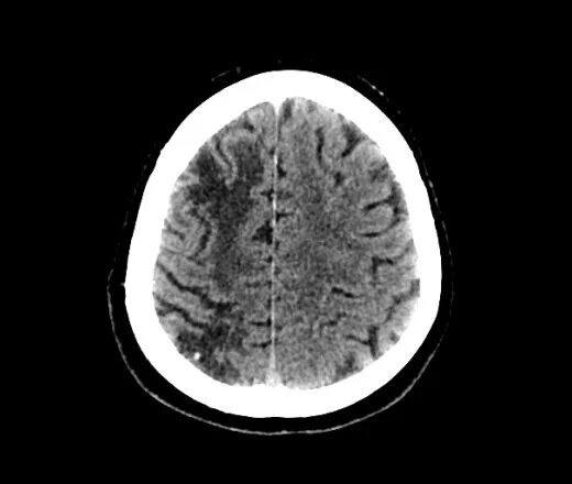 Постишемические кисты мозга. Постишемические изменения на мрт. Кт мягких тканей головы. Постишемические кисты на кт. Лакунарной постишемической кисты.